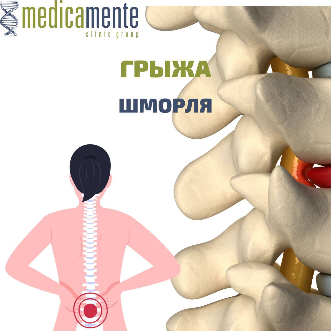 Как лечить грыжу шморля. Узелки Шморля. Позвонок кость.