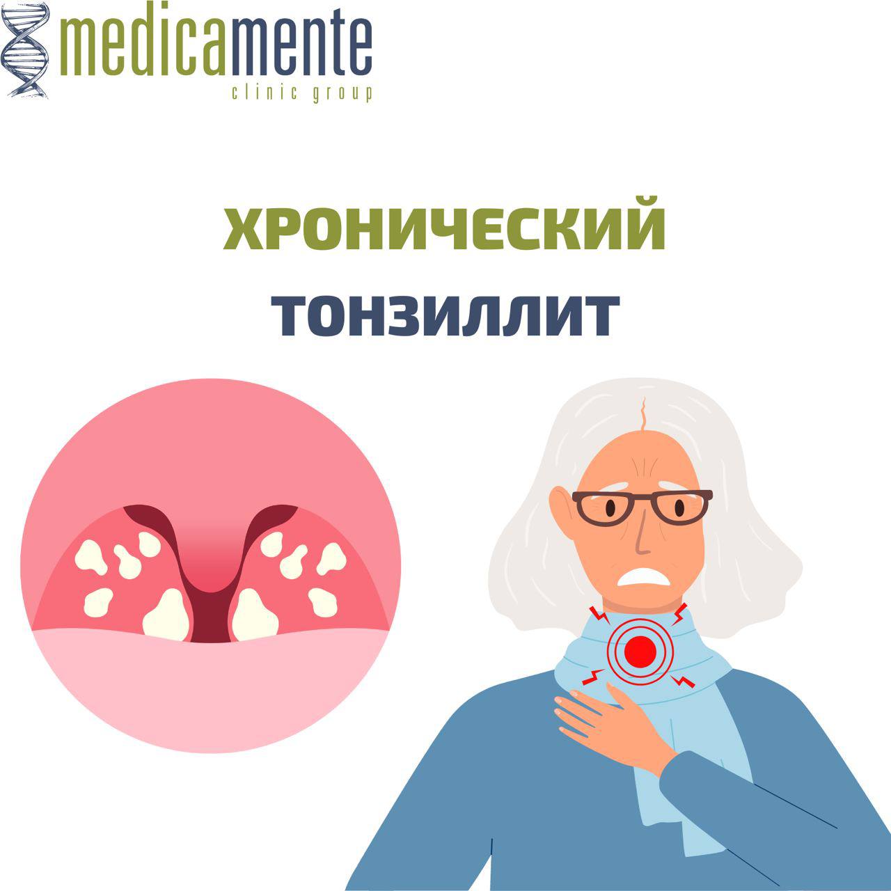 Хронический тонзиллит - Клиника в Праге MEDICA MENTE